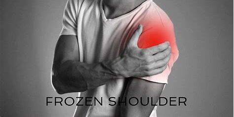 Getting rid of Frozen Shoulder